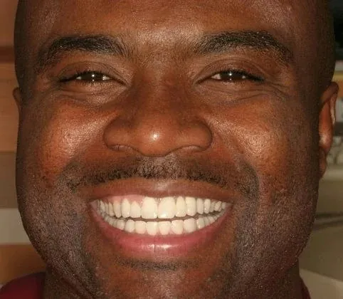 Rodney's smile after treatment at The Smile Center.